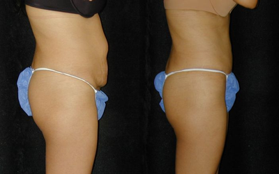 Tummy Tuck before and after photo