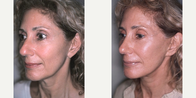 Facelift before and after photo