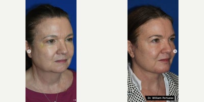 Facelift before and after photo