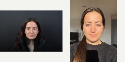 Revision Rhinoplasty before and after photo