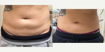 Smart Lipo before and after photo
