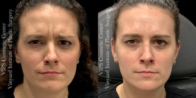 Botox before and after photo
