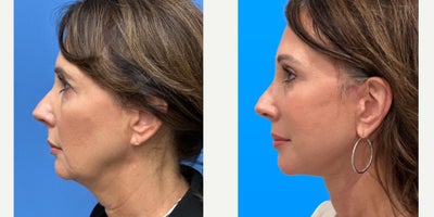 Brow Lift before and after photo