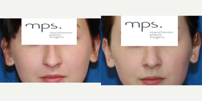 Rhinoplasty before and after photo