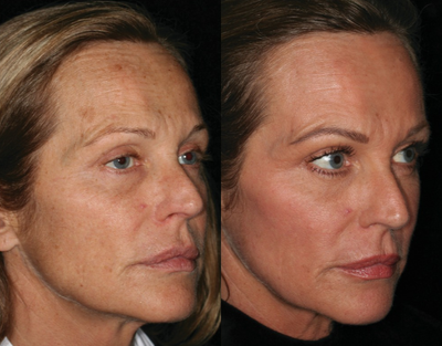 Laser Resurfacing before and after photo