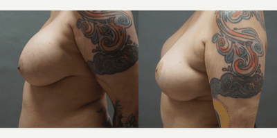 Breast Lift before and after photo