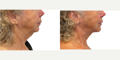 Deep Plane Facelift before and after photo