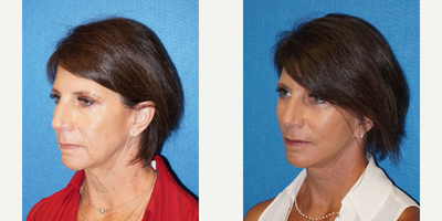 Facelift before and after photo
