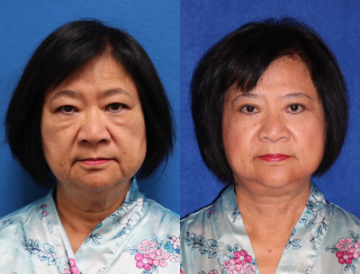 Facelift before and after photo