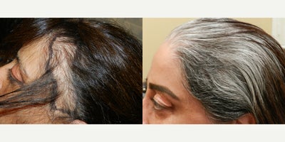 Hair Loss Treatment before and after photo