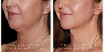 before and after image