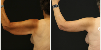 Arm Lift before and after photo