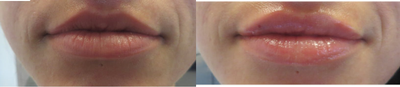Botox before and after photo