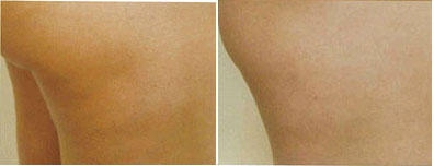 Cellulaze before and after photo