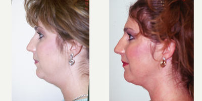 Chin Liposuction before and after photo