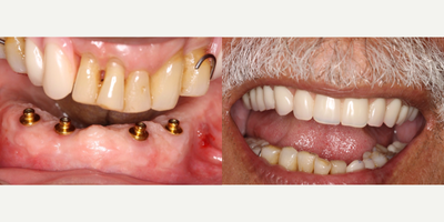 ClearChoice Dental Implants before and after photo