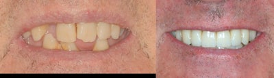 Dental Implants before and after photo