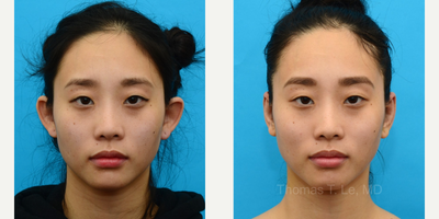 Ear Surgery before and after photo