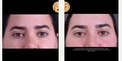 Eyelid Surgery before and after photo