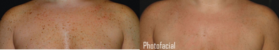 IPL before and after photo