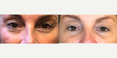 Restylane before and after photo