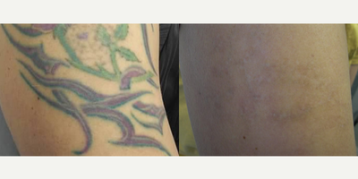 Tattoo Removal before and after photo