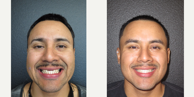 Dental Implants before and after photo