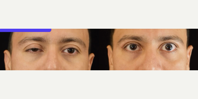 Eyelid Surgery before and after photo