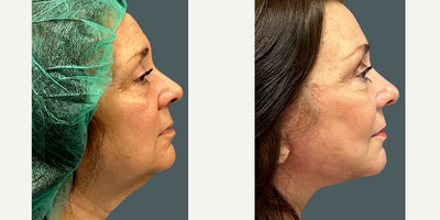 Facelift before and after photo