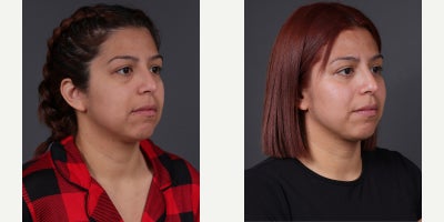 Facial Fat Transfer before and after photo