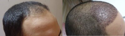 FUE Hair Transplant before and after photo