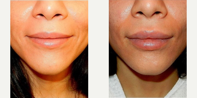Juvederm before and after photo