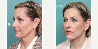 Neck Lift before and after photo