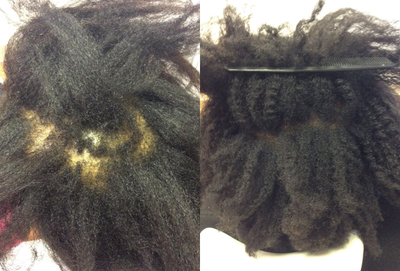 PRP for Hair Loss before and after photo