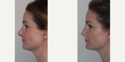 Revision Rhinoplasty before and after photo