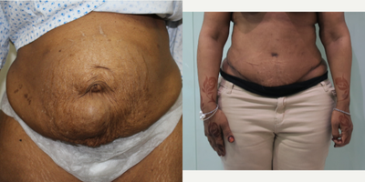 Tummy Tuck before and after photo