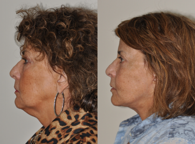 Deep Plane Facelift before and after photo
