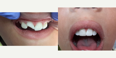 Dental Bonding before and after photo