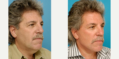 Facial Fat Transfer before and after photo