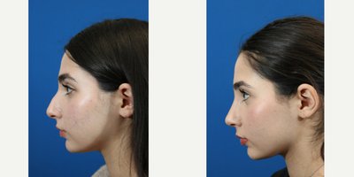 Rhinoplasty before and after photo