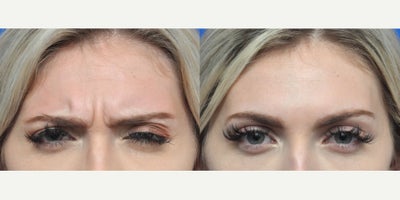 Botox before and after photo