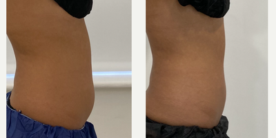 CoolSculpting before and after photo