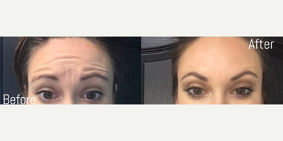 Dysport before and after photo