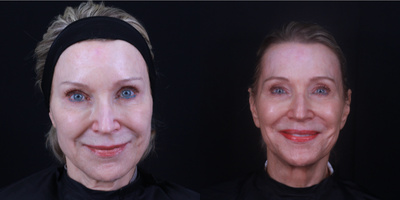 Lip Fillers before and after photo