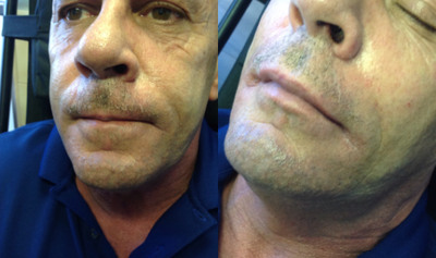Restylane Defyne before and after photo