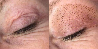 Skin Tightening before and after photo