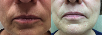 ThermiSmooth Face before and after photo