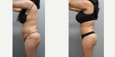 Brazilian Butt Lift before and after photo