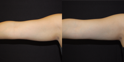 CoolSculpting before and after photo