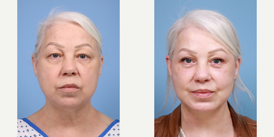 Eyelid Surgery before and after photo